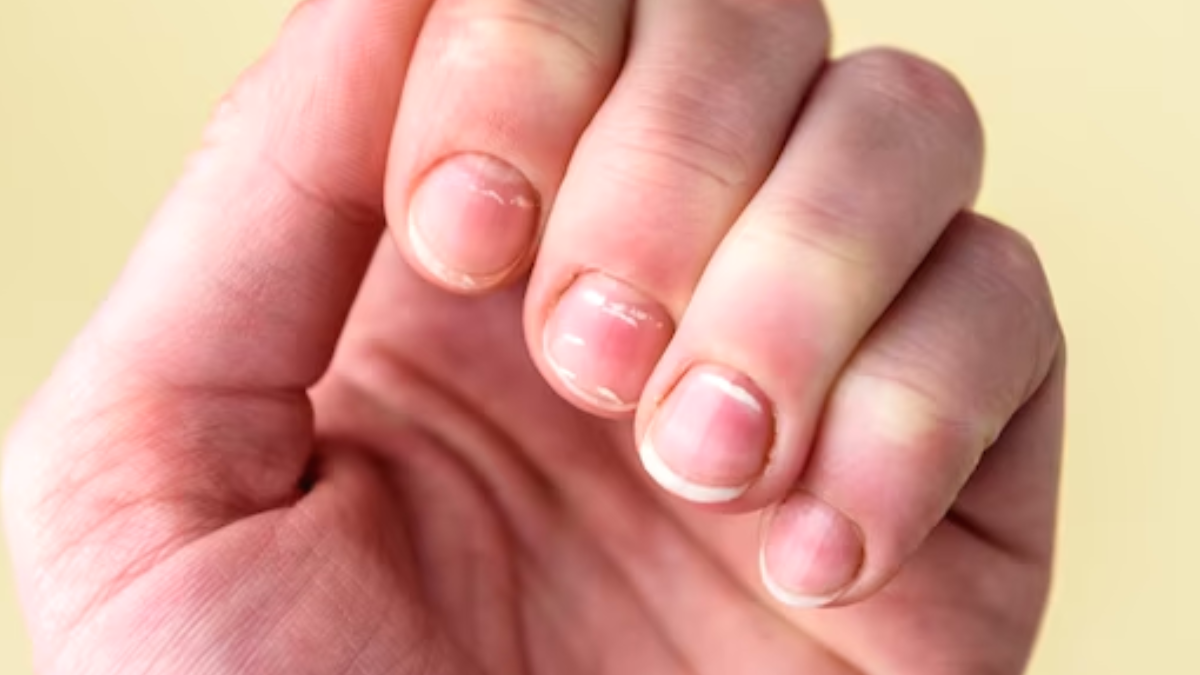 Manchas brancas nas unhas