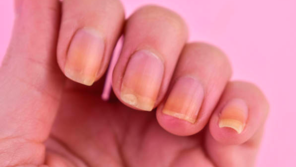 Unhas amarelas