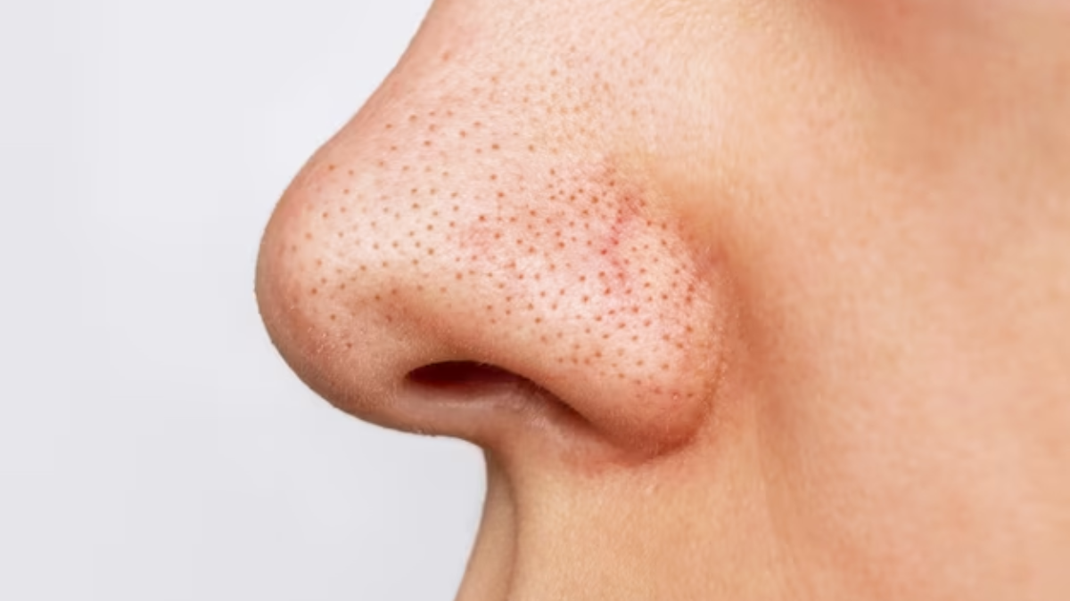 16 Dicas caseiras para remover cravos e ter uma pele PERFEITA! 9 Dicas caseiras para remover cravos