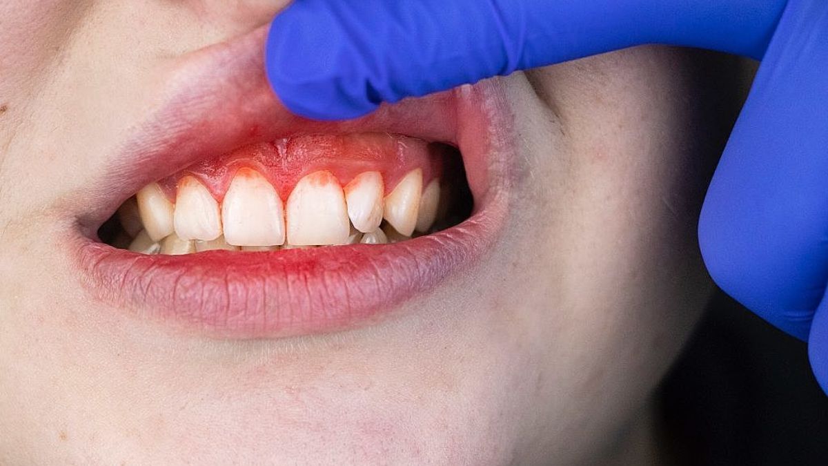 Sonhar com dentes sangrando