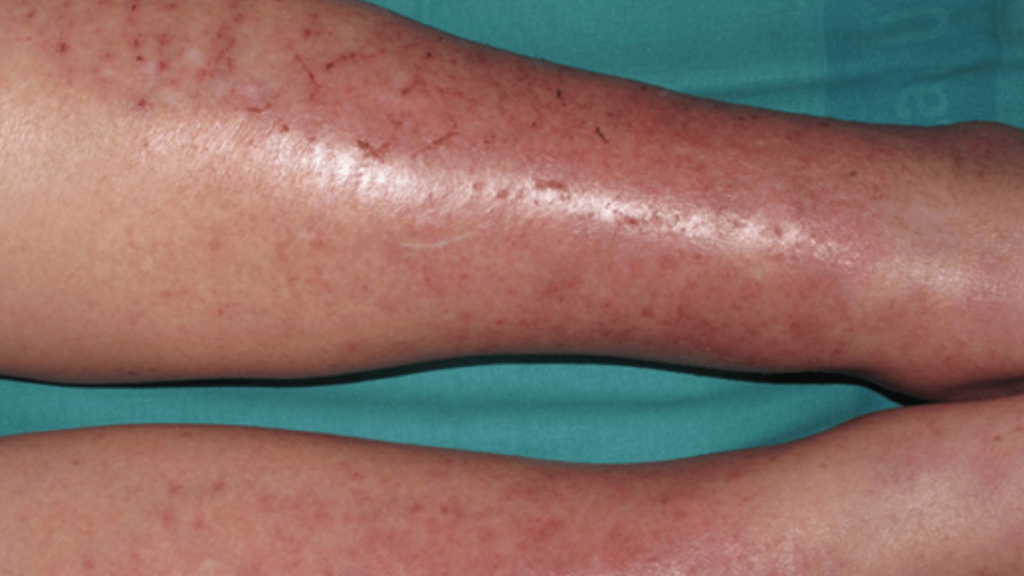 Eczema varicoso