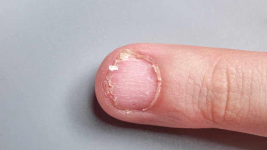 7 Dicas para fortalecer unhas quebradiças e como prevenir! 2 Unha quebrada
