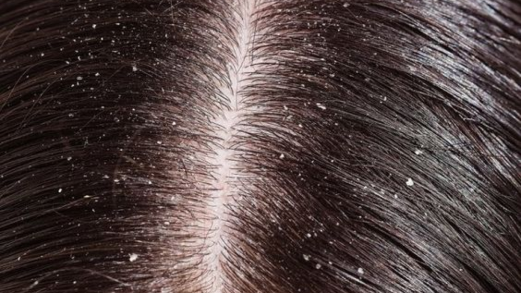 Significado De Sonhar Com Caspa: Saiba tudo o que indica! 1 Significado De Sonhar Com Caspa