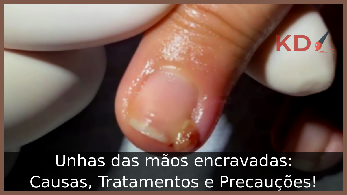 Unhas das mãos encravadas: Causas, Tratamentos e Precauções! 15 Unhas das mãos encravadas