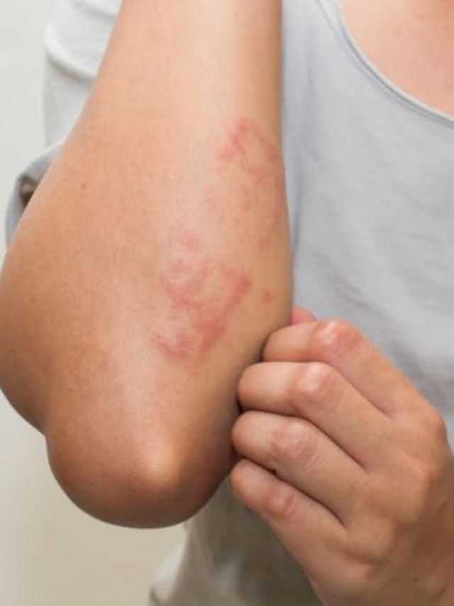 7 Ingredientes caseiros para passar alergia na pele